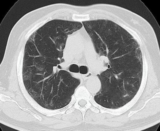 Spontaneous-Pneumomediastinum-3