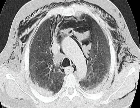 Spontaneous-Pneumomediastinum-6