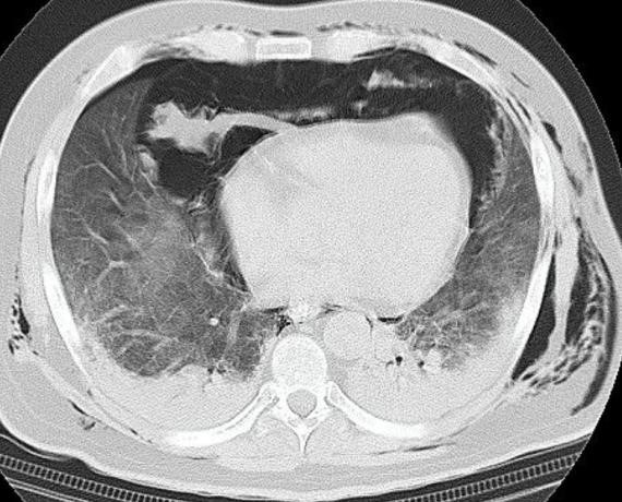 Spontaneous-Pneumomediastinum-7