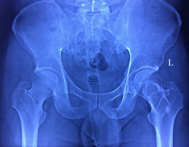 Prophylactic-orthopaedic-surgery-1
