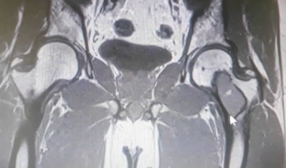 Prophylactic-orthopaedic-surgery-2