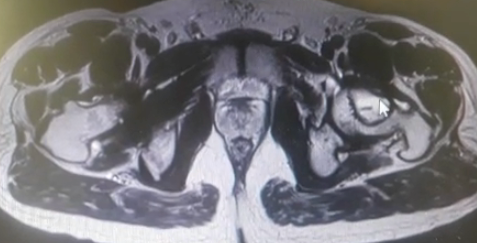 Prophylactic-orthopaedic-surgery-3