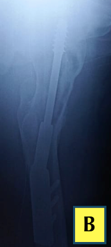 Prophylactic-orthopaedic-surgery-5