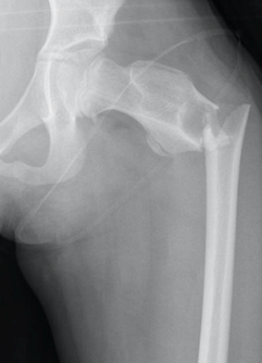 Prophylactic-orthopaedic-surgery-6