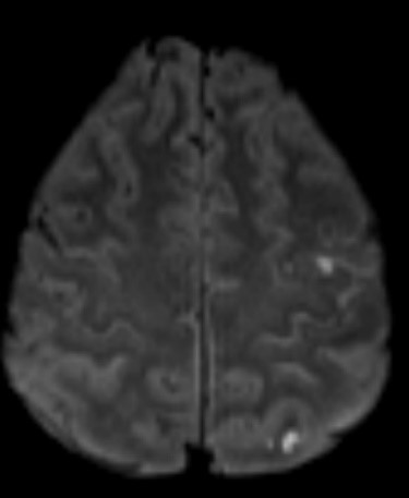 Subclavian-steal-2