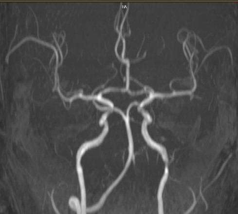 Subclavian-steal-4