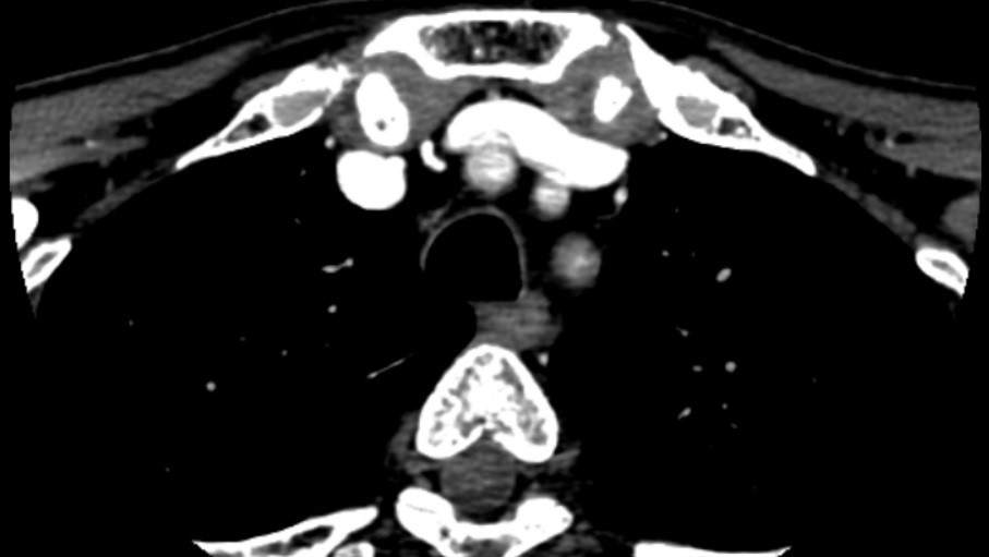 Subclavian-steal-6