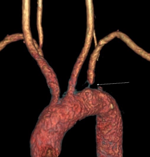 Subclavian-steal-7