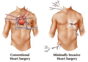 Pain-free-CABG-1