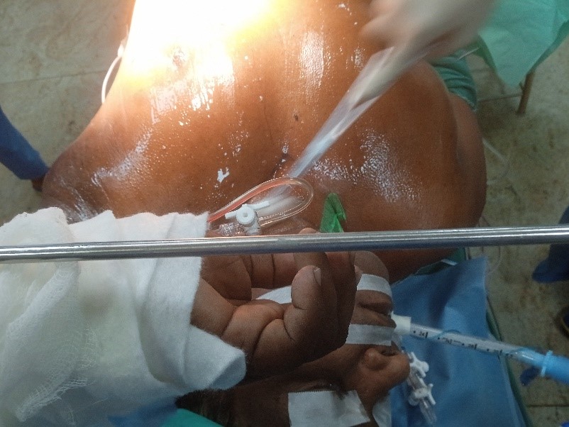 Pain-free-CABG-3