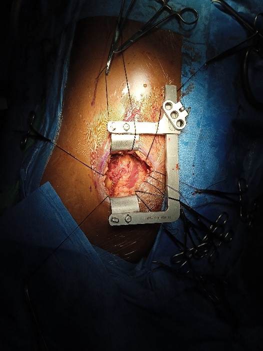 Pain-free-CABG-4