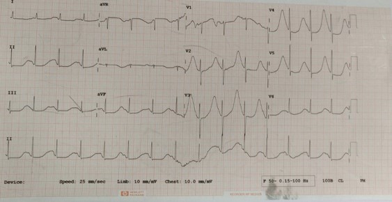 Stellate-Ganglion-Block-1
