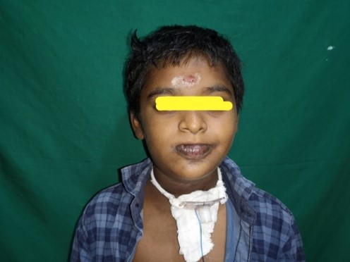 Venous-Malformation-in-Upper-Airway-6