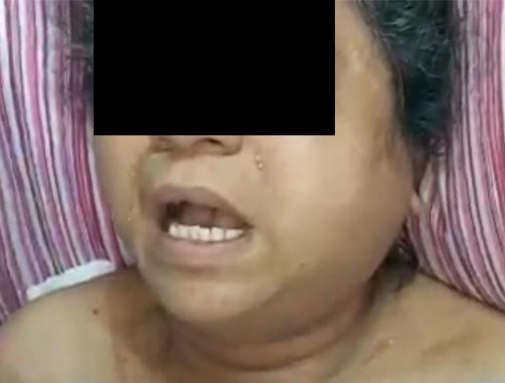 Parapharyngeal-abscess-1