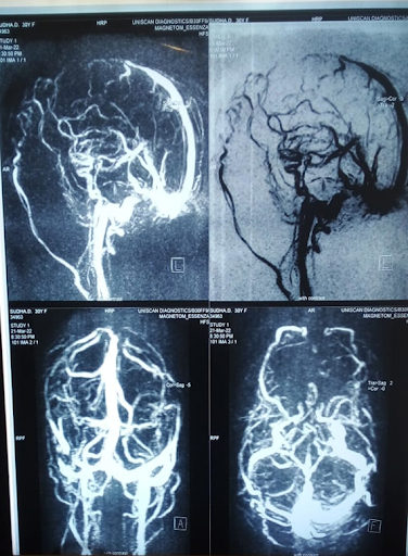 CT-brain-1