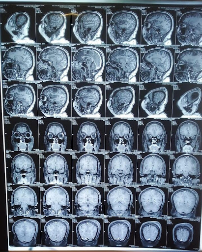 CT-brain