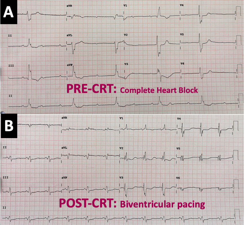 cardiac-resynch2