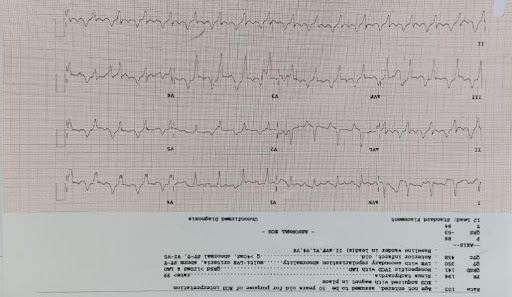 Hyperkalemia-1