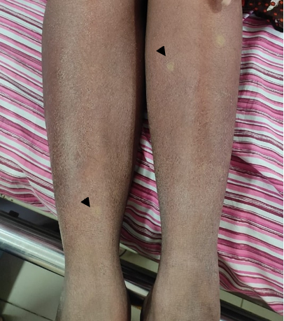 Convalescent-rash-1