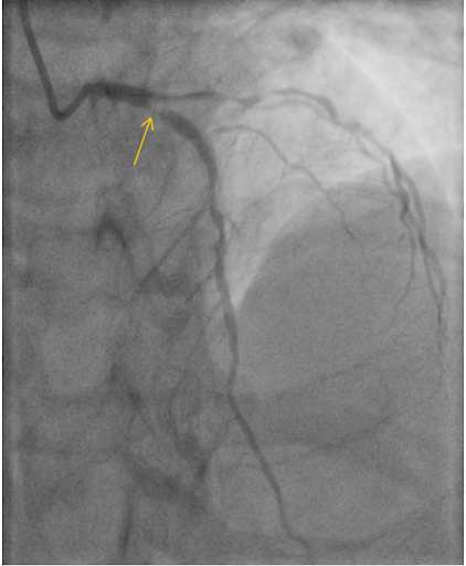 Eponymous-ECG-2