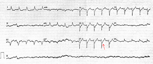 Eponymous-ECG-4