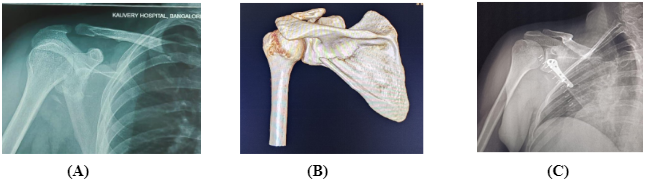 scapula1