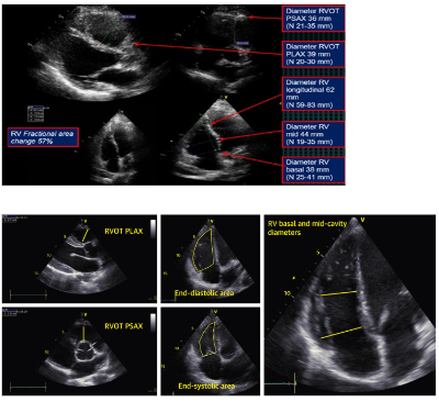 Cardiomyopathy10