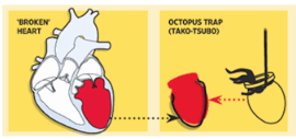 Cardiomyopathy11