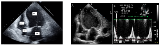 Cardiomyopathy12