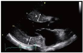Cardiomyopathy2
