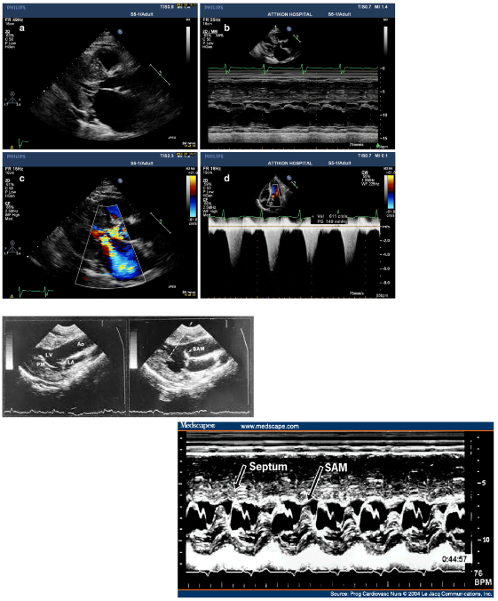 Cardiomyopathy3