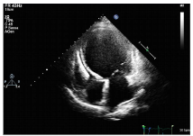Cardiomyopathy4