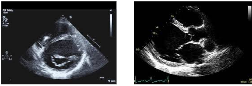 Cardiomyopathy5
