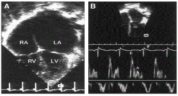 Cardiomyopathy6
