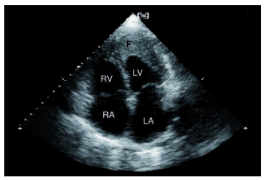 Cardiomyopathy8