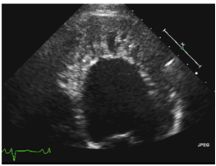 Cardiomyopathy9