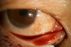eye1