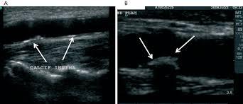 Arterial-mapping-of-upper-limb
