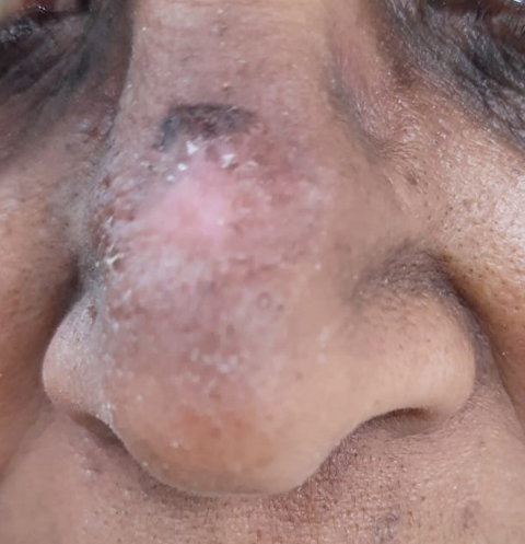 Pretreatment-clinical-photograph-1