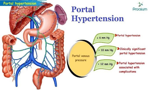 Pulmonary-Hypertension-1