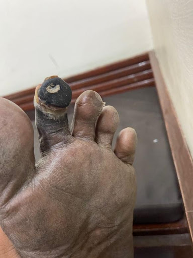 Toe-tip-gangrene