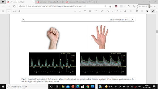 Triphasic-arterial-waveform