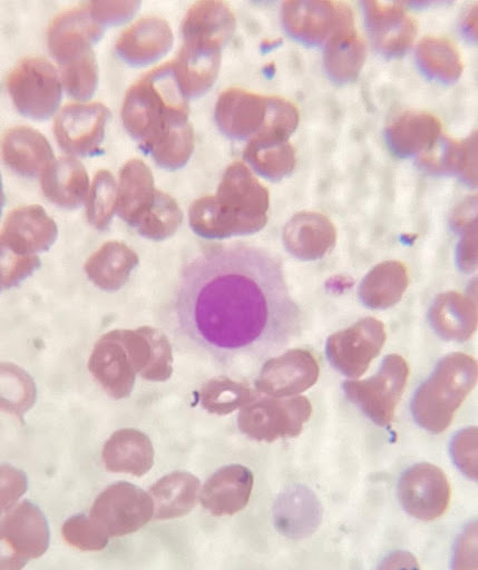 Hairy cells