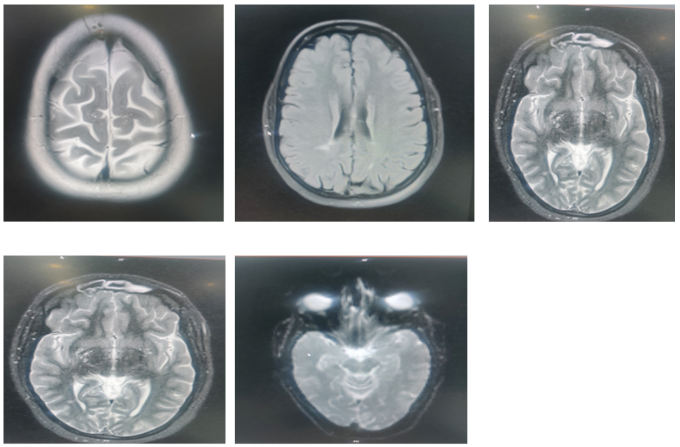 Internuclear-Ophthalmoparesis1