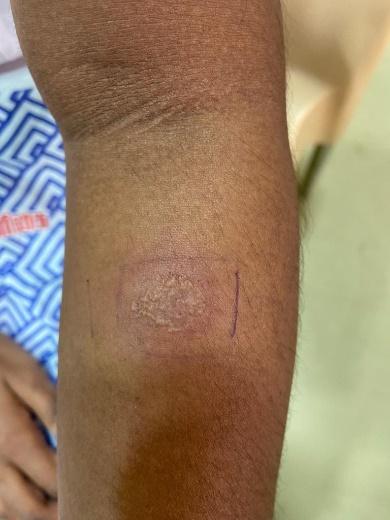 Positive-Mantoux-reaction