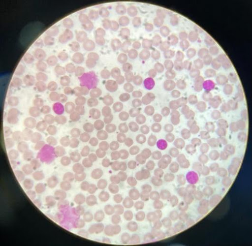 Smudge-cells