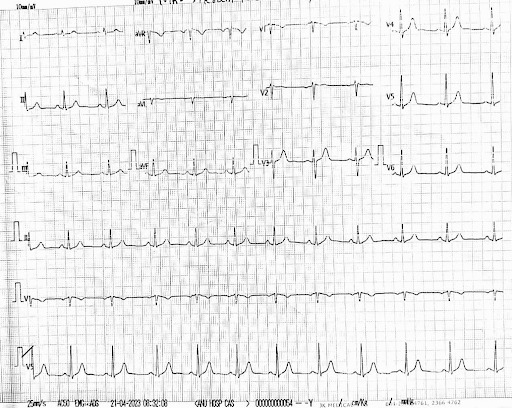 ECG-recovery