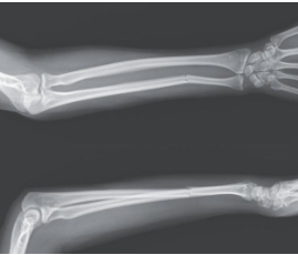 Isolated-Ulnar
