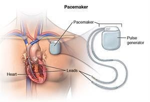 PPI-illustration-Image