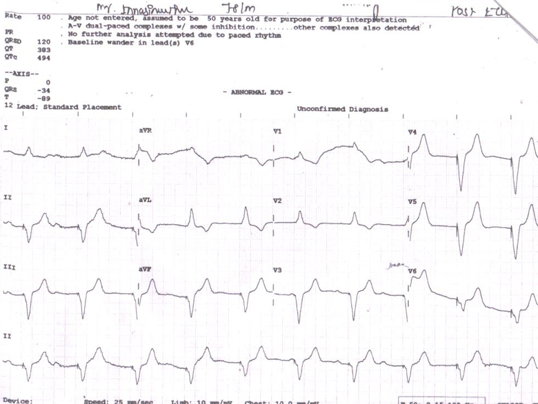 Post-ECG
